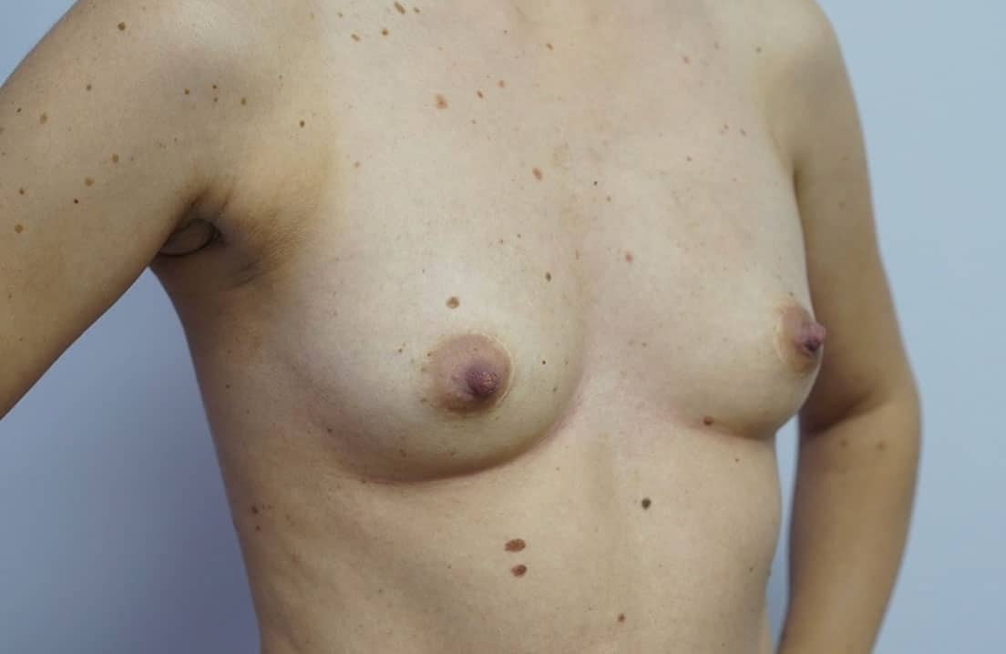 Breast Augmentation Melbourne