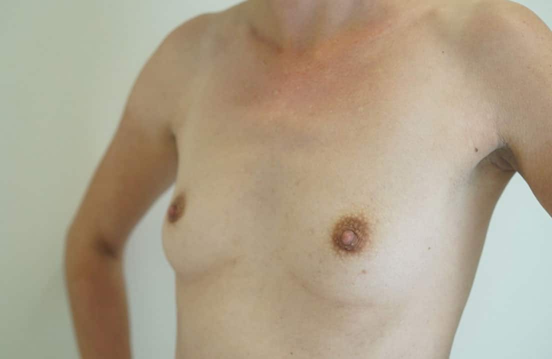 Breast Augmentation Melbourne