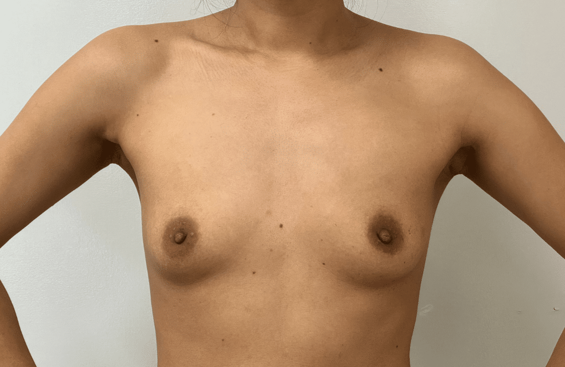 Breast Augmentation Melbourne